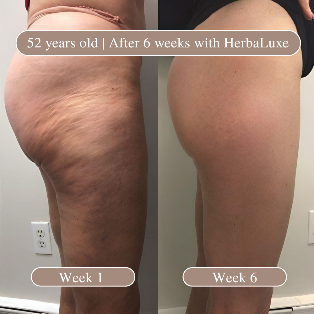 HerbaLuxe Anti-Cellulite Massage Oil